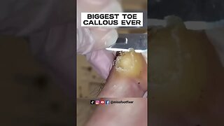 SHAVING OF REAL BIG TOE CALLUS 🦶 BIGGEST TOE CALLOUS EVER FULL TREATMENT BY MISS FOOT FIXER