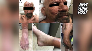 Leprosy on the rise in Florida: CDC health alert