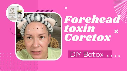 Forehead toxin and mapping | diy Botox using Coretox