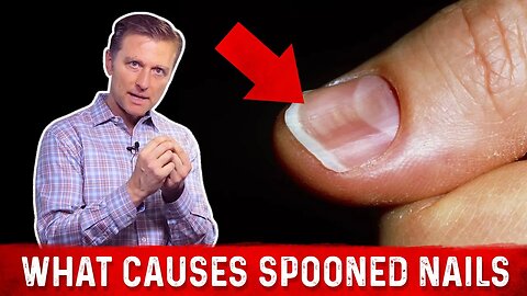 Spoon Nails: Causes & Treatments By Dr. Berg