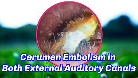 Cerumen Embolism in Both External Auditory Canals