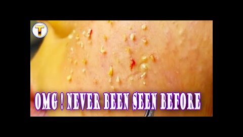 Doctor Clean Blackhead on the face woman very dirty