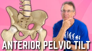 Anterior Pelvic Tilt? Do You Have It? How to Fix? A BIG SURPRISE!