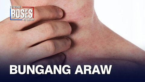 Health expert, nagpaalala para iwas bungang araw ngayong tag-init
