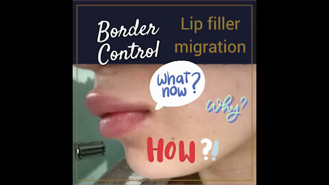 Lip Filler Migration