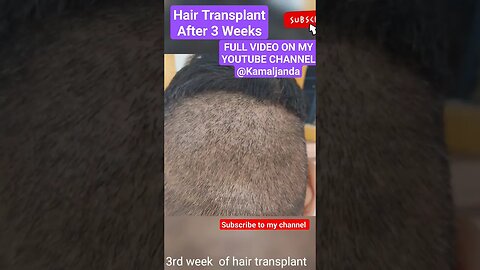 Hair Transplant -Everything You need to know