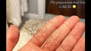 Lea Michele has postpartum hair loss