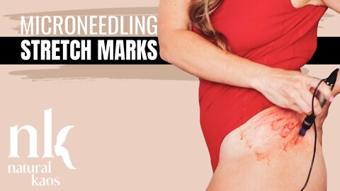 Microneedling Stretch Marks