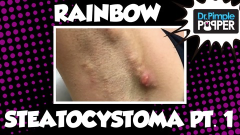Meet "Rainbow Steatocystoma": Session One, Part One