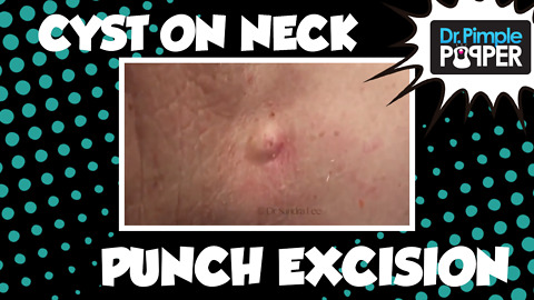 Removal of Cyst on Neck