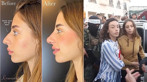 Israeli and recent Hamas hostage Mia Schem gets Nose Job