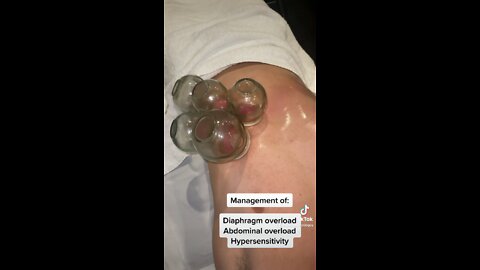 Fire cupping - Anterior rib cage focus