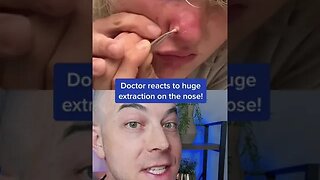 Doctor reacts to massive nose pimple extraction! #nosepimple #pimplepopper #dermreacts