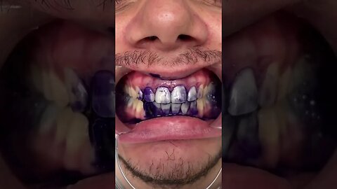 Teeth Whitening | link In comments