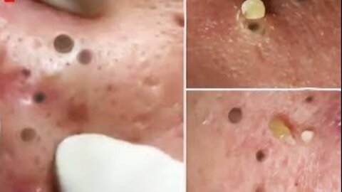 Blackhead Extraction Most Satisfying Video For Facial Skin Care