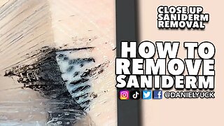 How To Remove Saniderm?