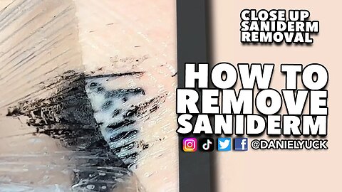 How To Remove Saniderm?