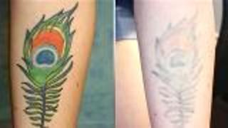 Serious About Removing Your Tattoo?