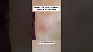 EXTRACTION OF DOUBLE DEEP SEEDED CORN ON SOLE OF FEET 2023 BY FAMOUS PODIATRIST MISS FOOT FIXER