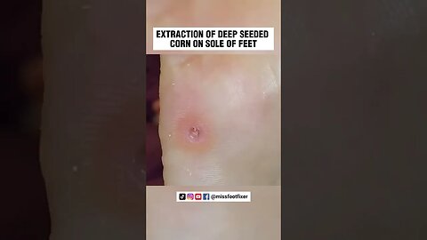 EXTRACTION OF DOUBLE DEEP SEEDED CORN ON SOLE OF FEET 2023 BY FAMOUS PODIATRIST MISS FOOT FIXER