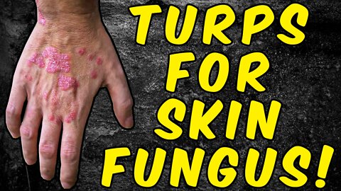 How To Eliminate Skin Candida/Fungus With Turpentine!