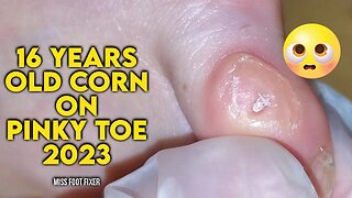 16 YEARS OLD SUPER PAINFUL CORN REMOVAL 2023 BY FOOT DOCTOR MISS FOOT FIXER