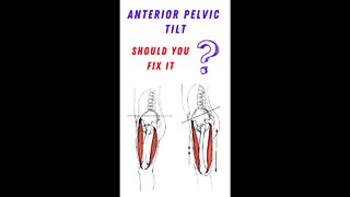 How to fix anterior pelvic tilt?