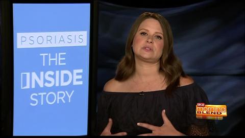 ABC's Scandal's Katie Lowes talks living with Psoriasis