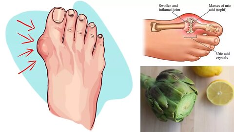 Eliminate Gout and High Uric Acid Levels With Artichoke and Lemon Water