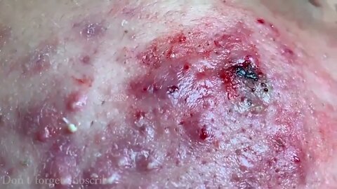 Removal / extraction Blackheads & Milia, Big Cystic Acne Blackheads Extraction Whiteheads Removal