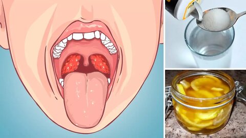 5 Strep Throat Home Remedies to Treat a Sore Throat Naturally