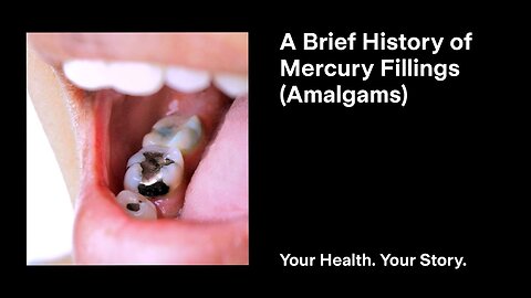 A Brief History of Mercury Fillings (Amalgams)