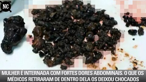 Mulher é internada com fortes dores abdominais. O que os médicos retiraram de dentro dela...