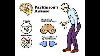 Study links mrna "vaccines" to Parkinson's disease.