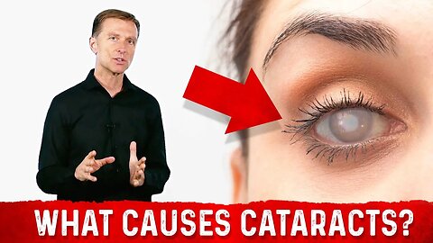 What Causes Cataracts? – Dr. Berg