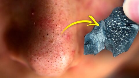 How to Get Rid of Blackheads on Your Nose