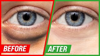 How to Get Rid of Puffy Eyes and Dark Circles