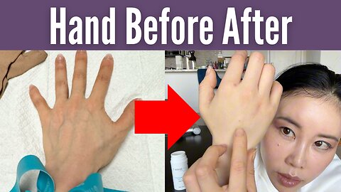 Hand rejuvenation therapies: Before and after | Koko Face Yoga