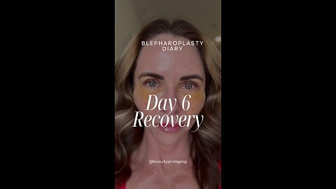 Day 6 Recovery | Eyelid Lift Surgery with Fat Transfer