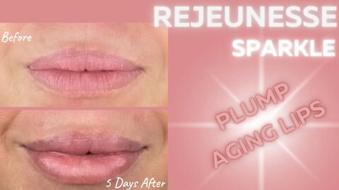 Lip Filler with Rejeunesse Sparkle - Estaderma SASSY15 saves 15% Daily