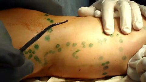 Microflebectomia. Cirurgia para remoção de varizes através de punções na pele. Anatômico