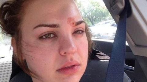 The Disastrous Results of this Young Woman’s Popped Pimple