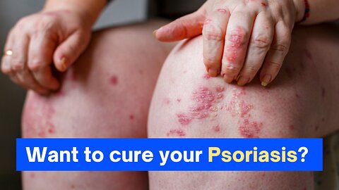 How To Get rid of all types of Psoriasis