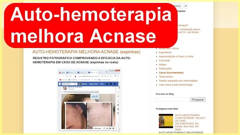 AUTO-HEMOTERAPIA MELHORA ACNASE (espinhas) por E.B.R.