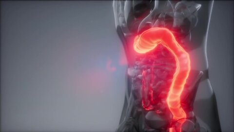 Doctors say colon cancer is preventable