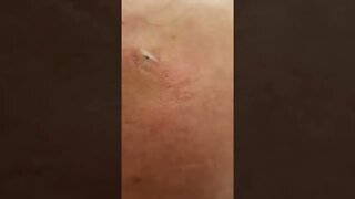 Remoção de Cravos e Espinhas - Remove Squeezing Blackheads and Pimples - Just Relax | Apenas Relaxe