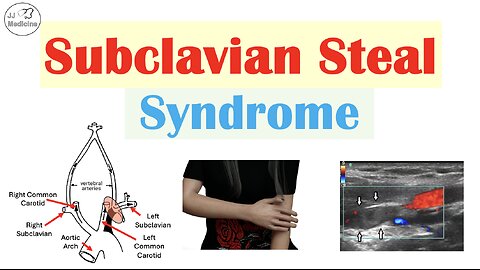 Subclavian Steal Syndrome (“Stealing Blood From Brain”) Risk Factors, Symptoms, Diagnosis, Treatment