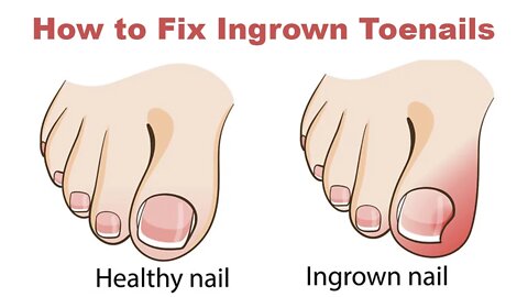 How to Fix Ingrown Toenails At Home