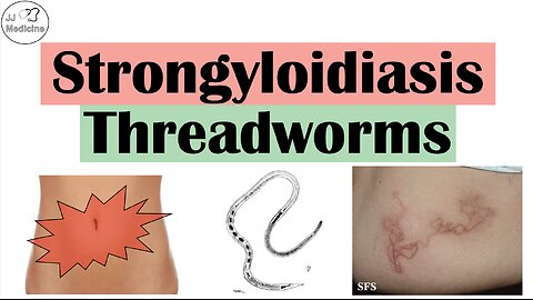 Strongyloidiasis (Threadworms) | Causes, Pathophysiology, Signs and Symptoms, Diagnosis, Treatment