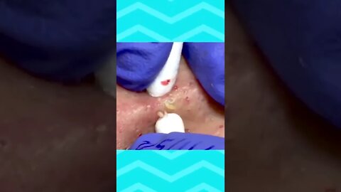 Blackheads and Pimples Removal Skin Cleansing #1 Relaxing Videos